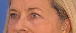 CO2RE Laser Before & After Gallery - Patient 140276 - Image 10