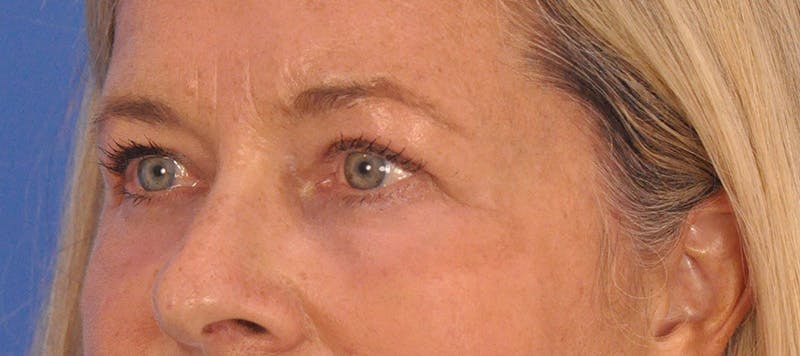 CO2RE Laser Before & After Gallery - Patient 140276 - Image 10