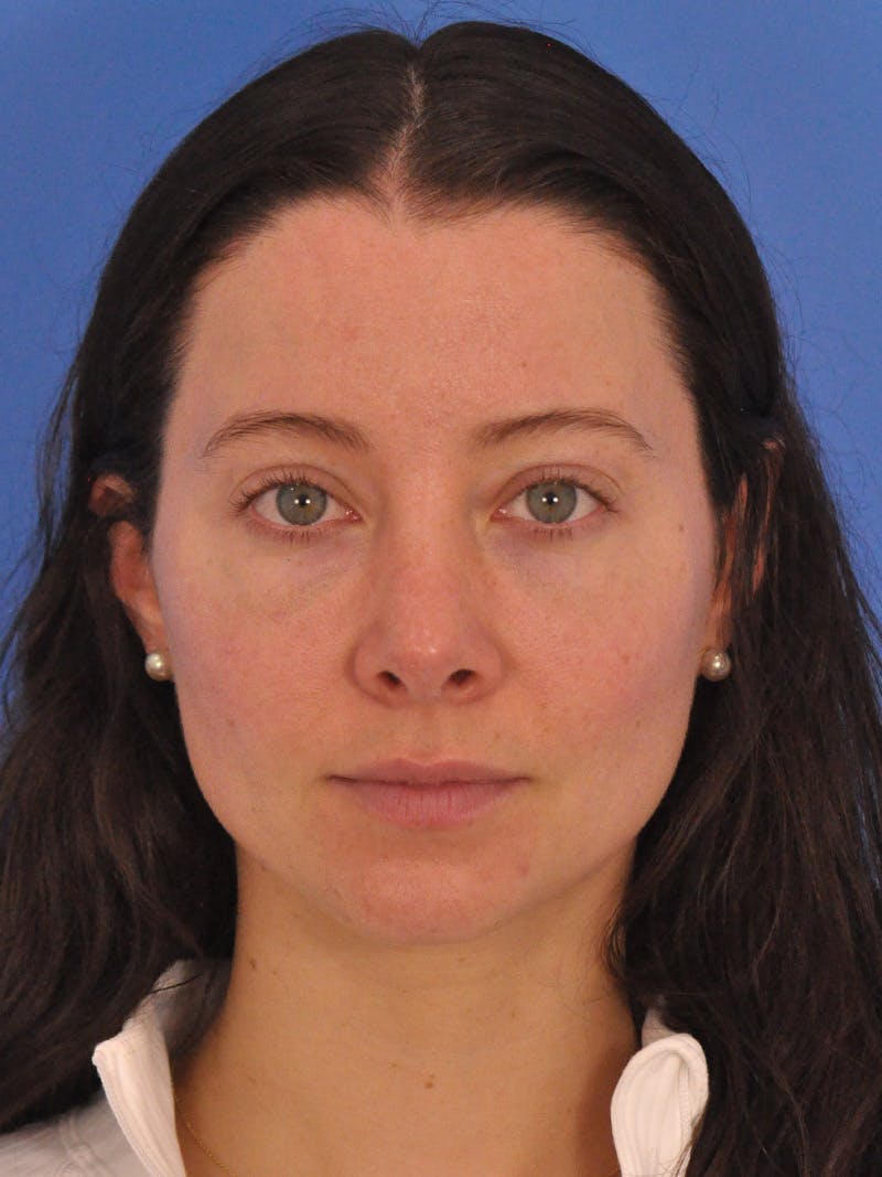 Cheek Filler Before & After Gallery - Patient 385411 - Image 1