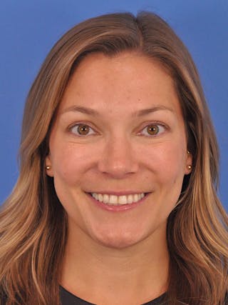 Cheek Filler Before & After Gallery - Patient 187973 - Image 4