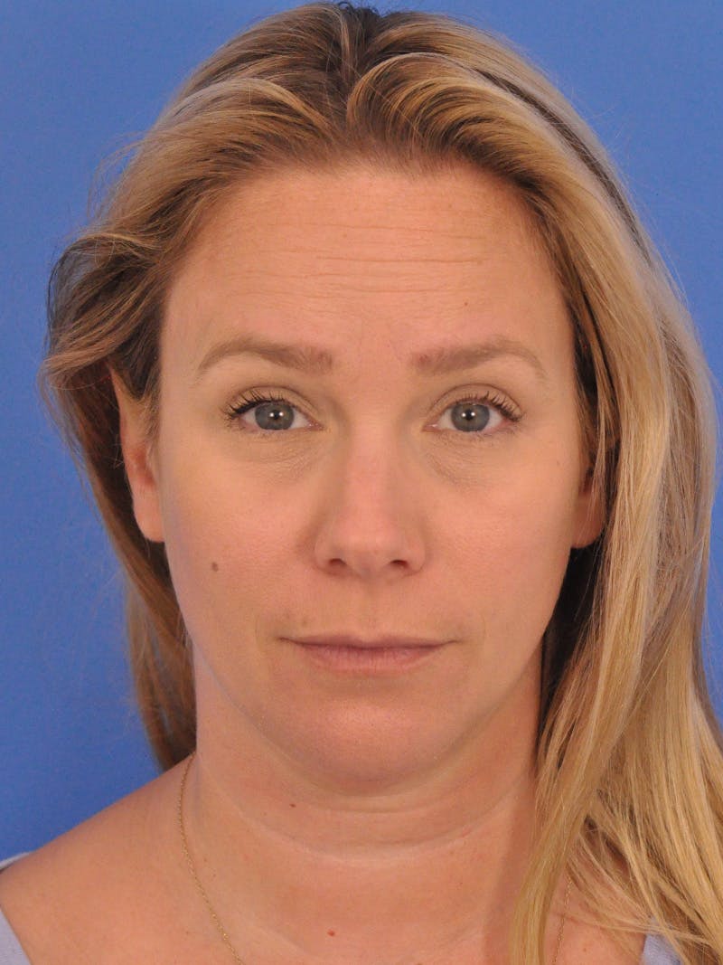 BOTOX Before & After Gallery - Patient 749775 - Image 6