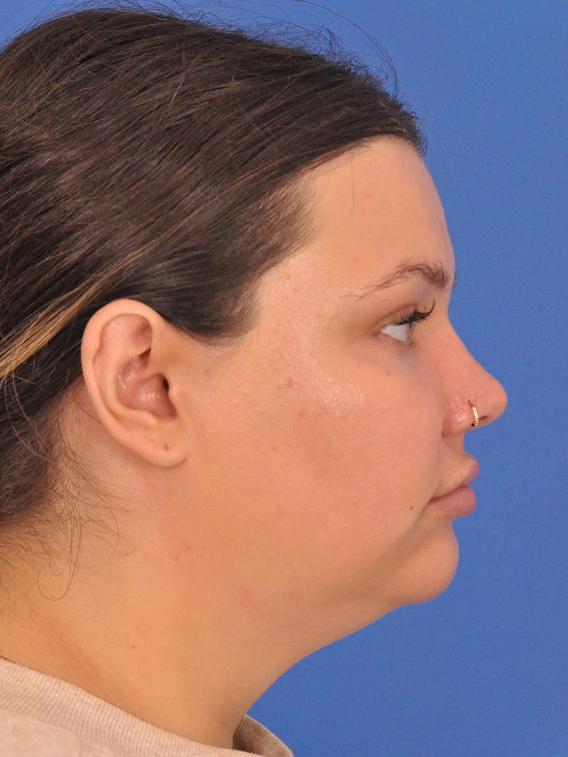 Chin Augmentation Before & After Gallery - Patient 174515 - Image 1