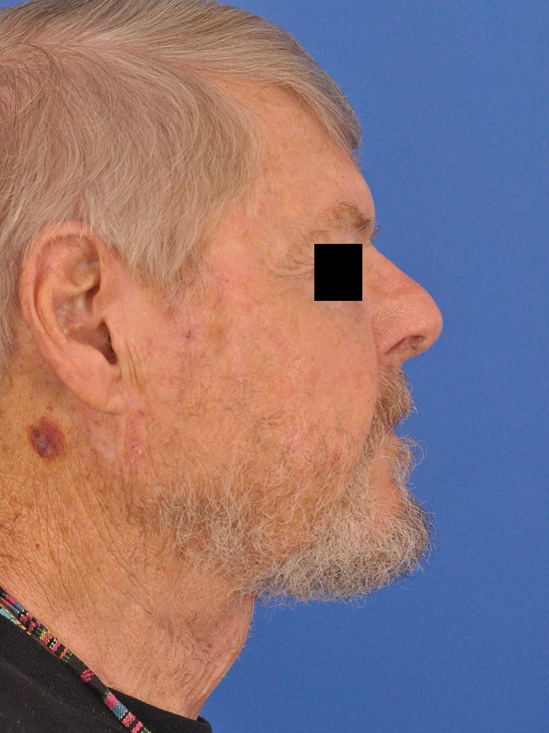 Neck Lift Before & After Gallery - Patient 891184 - Image 2