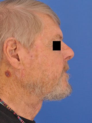 Neck Lift Before & After Gallery - Patient 891184 - Image 2