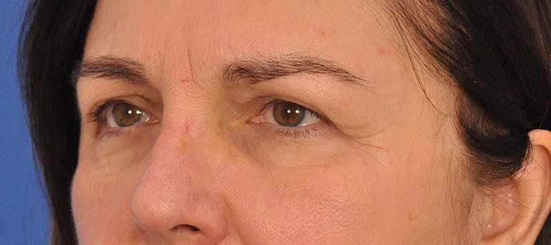 Blepharoplasty Before & After Gallery - Patient 761684 - Image 7