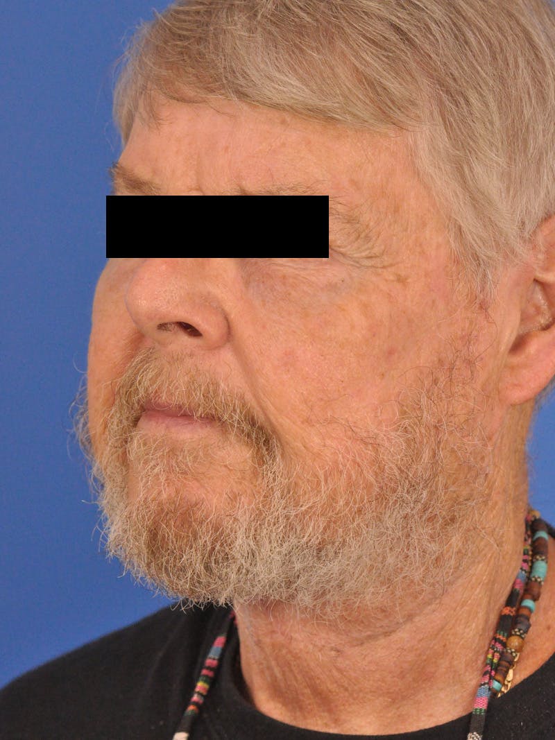 Neck Lift Before & After Gallery - Patient 891184 - Image 8