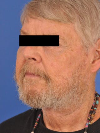 Neck Lift Before & After Gallery - Patient 891184 - Image 8