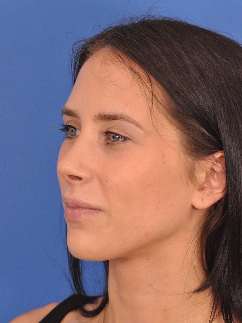 Rhinoplasty Before & After Gallery - Patient 405044 - Image 8