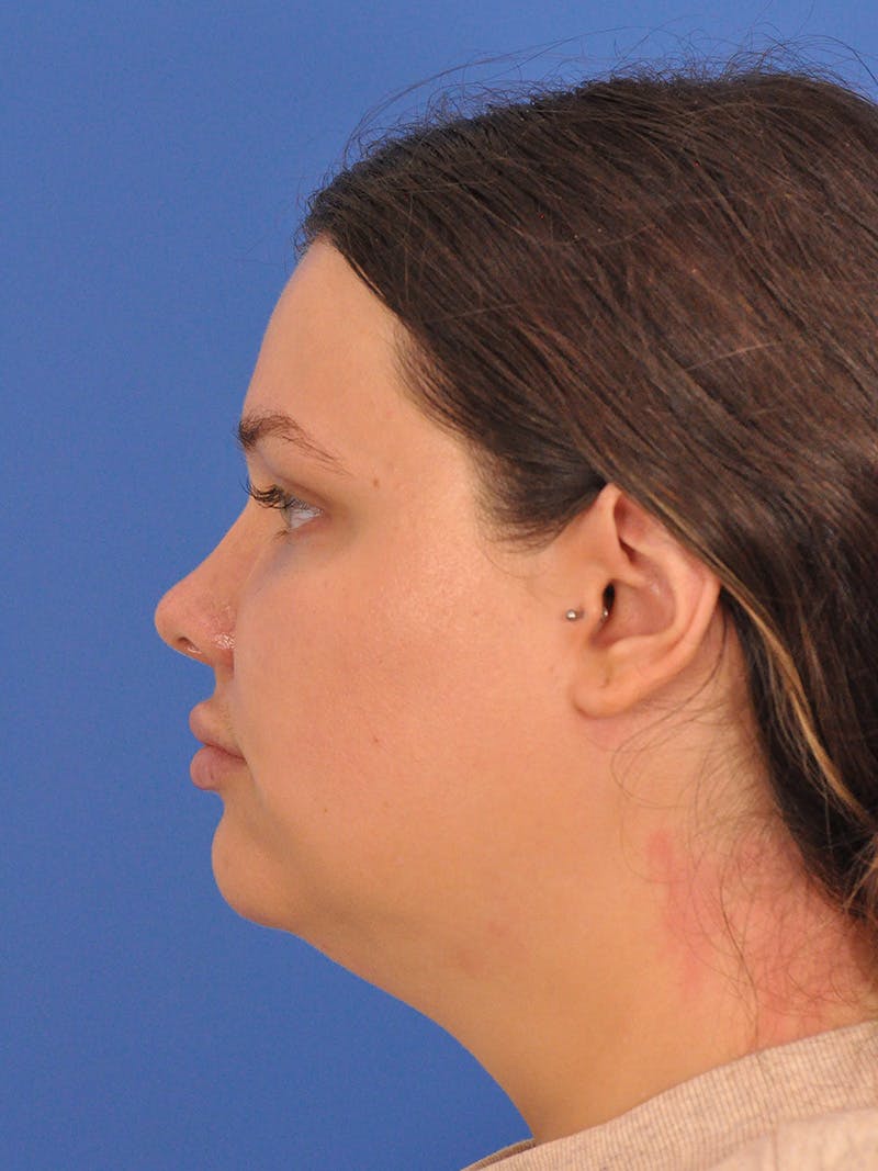 Chin Augmentation Before & After Gallery - Patient 174515 - Image 9