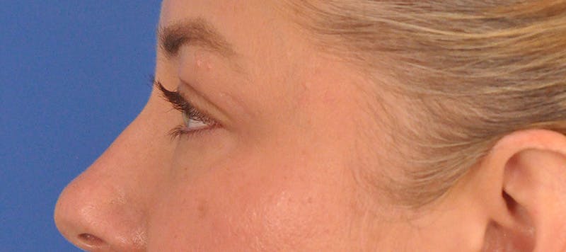 Blepharoplasty Before & After Gallery - Patient 391503 - Image 11