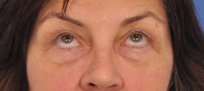 Blepharoplasty Before & After Gallery - Patient 358961 - Image 1