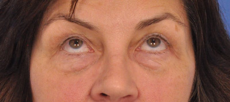 Blepharoplasty Before & After Gallery - Patient 358961 - Image 1