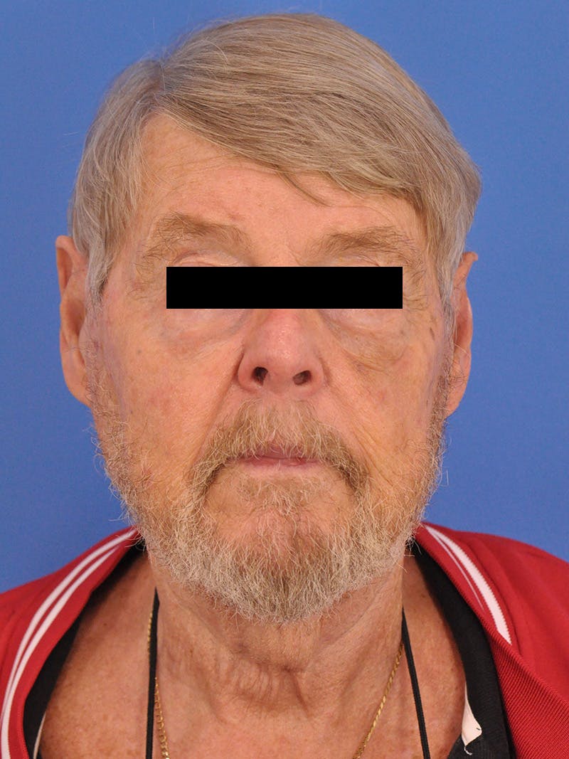 Neck Lift Before & After Gallery - Patient 891184 - Image 5