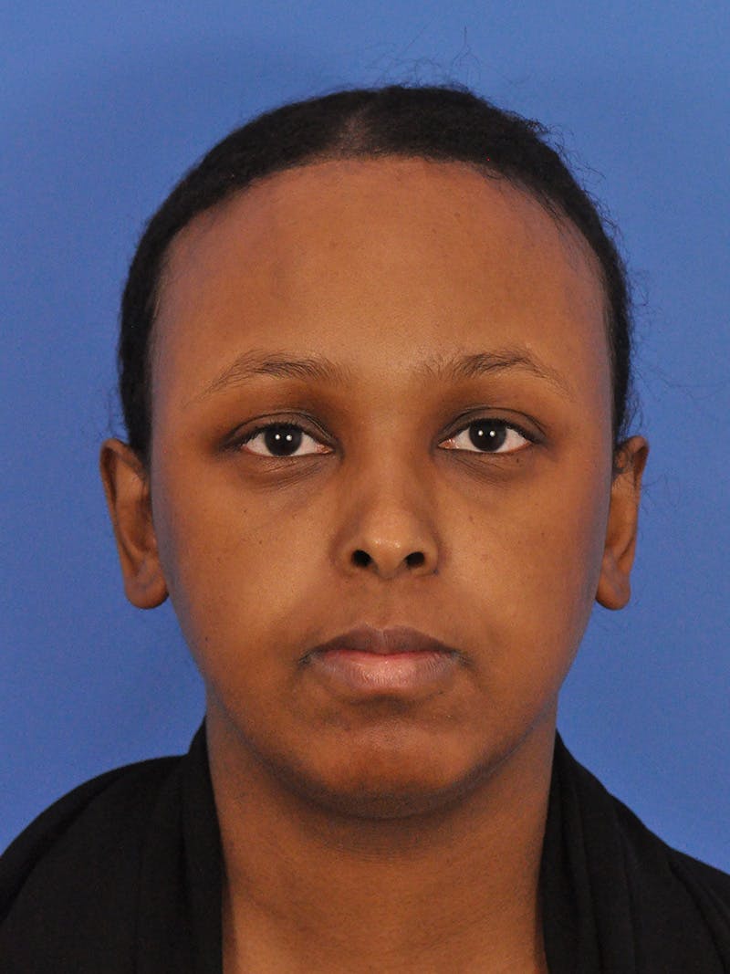 Forehead Reduction Before & After Gallery - Patient 196323 - Image 2