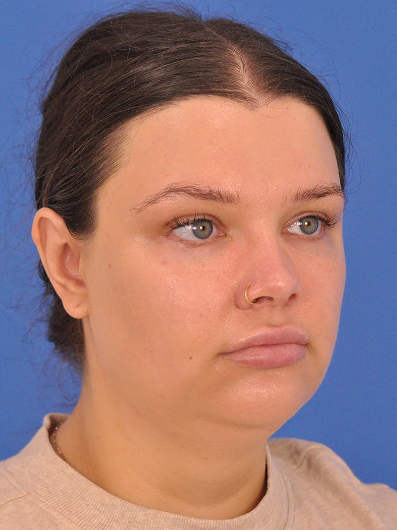 Chin Augmentation Before & After Gallery - Patient 174515 - Image 3