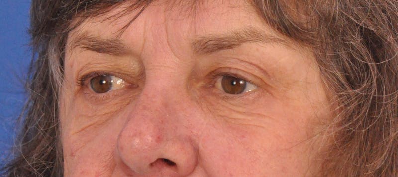 Blepharoplasty Before & After Gallery - Patient 110122 - Image 3