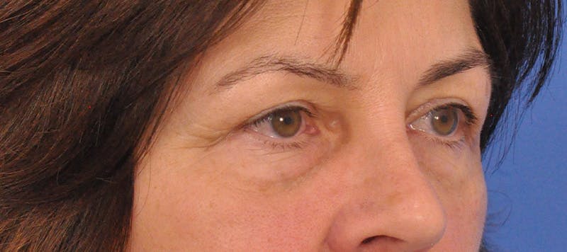 Blepharoplasty Before & After Gallery - Patient 358961 - Image 5