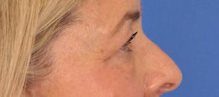 CO2RE Laser Before & After Gallery - Patient 140276 - Image 8