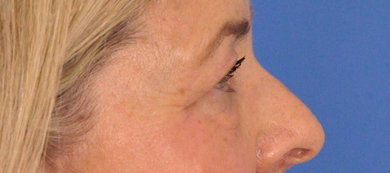 CO2RE Laser Before & After Gallery - Patient 140276 - Image 8