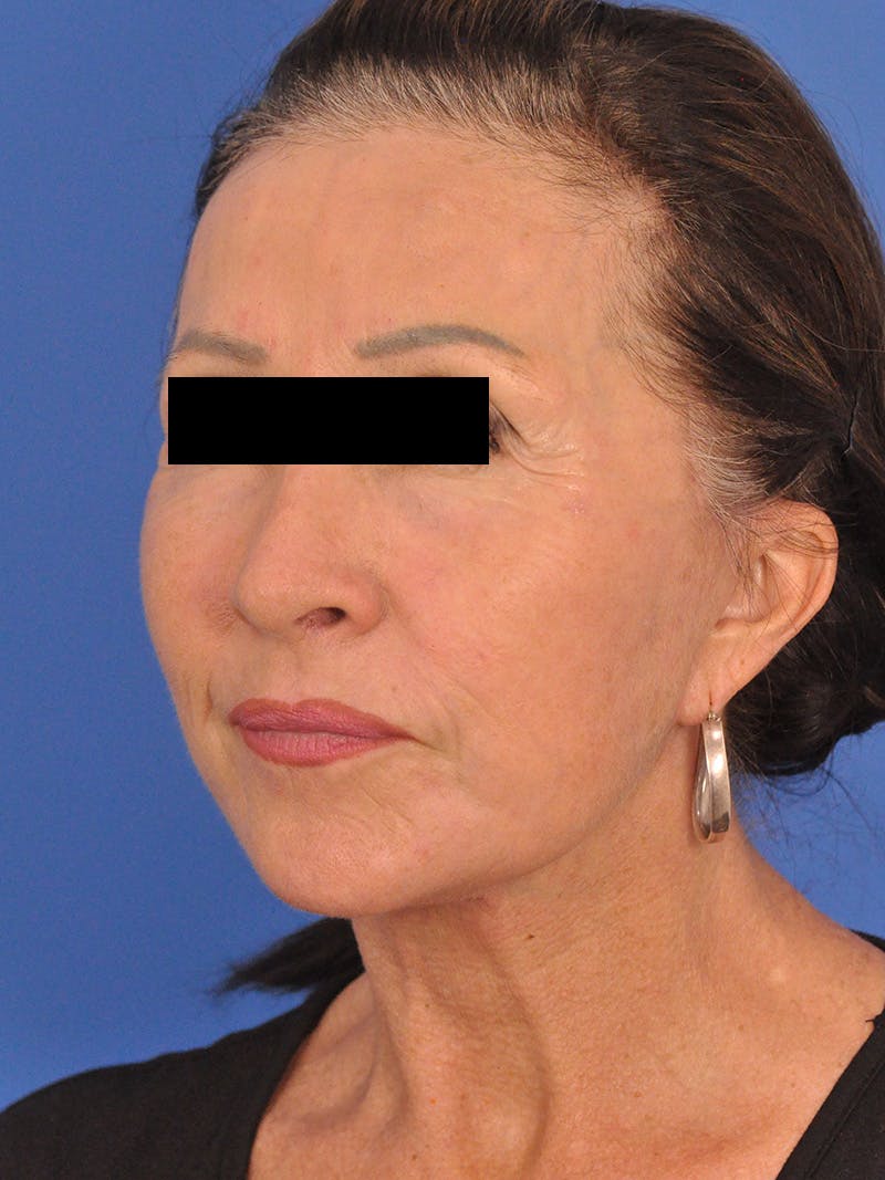 Neck Lift Before & After Gallery - Patient 128768 - Image 8