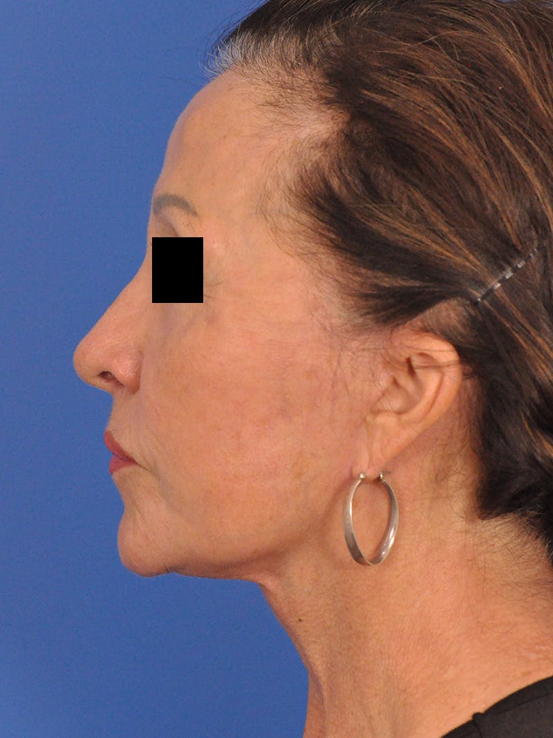 Neck Lift Before & After Gallery - Patient 128768 - Image 10