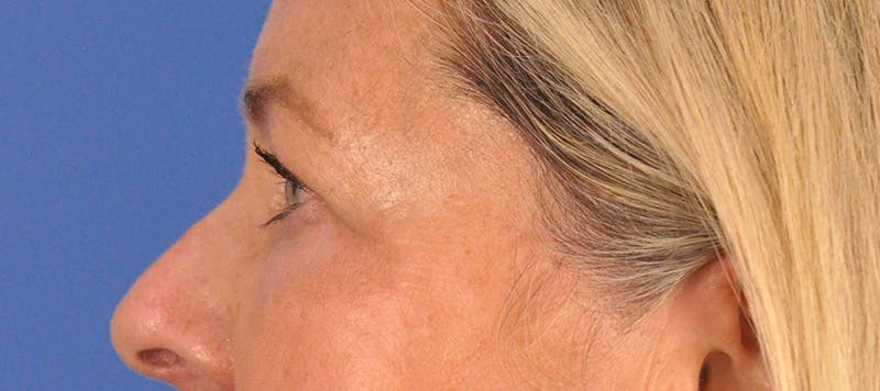 CO2RE Laser Before & After Gallery - Patient 140276 - Image 11