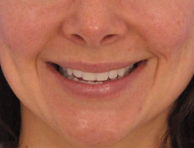 Lip Filler Before & After Gallery - Patient 829353 - Image 1