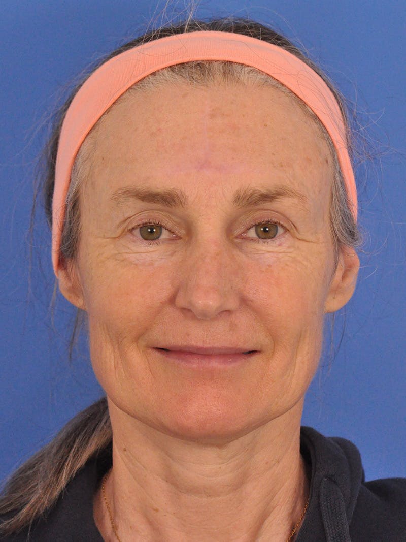 Vbeam Laser Before & After Gallery - Patient 348841 - Image 2