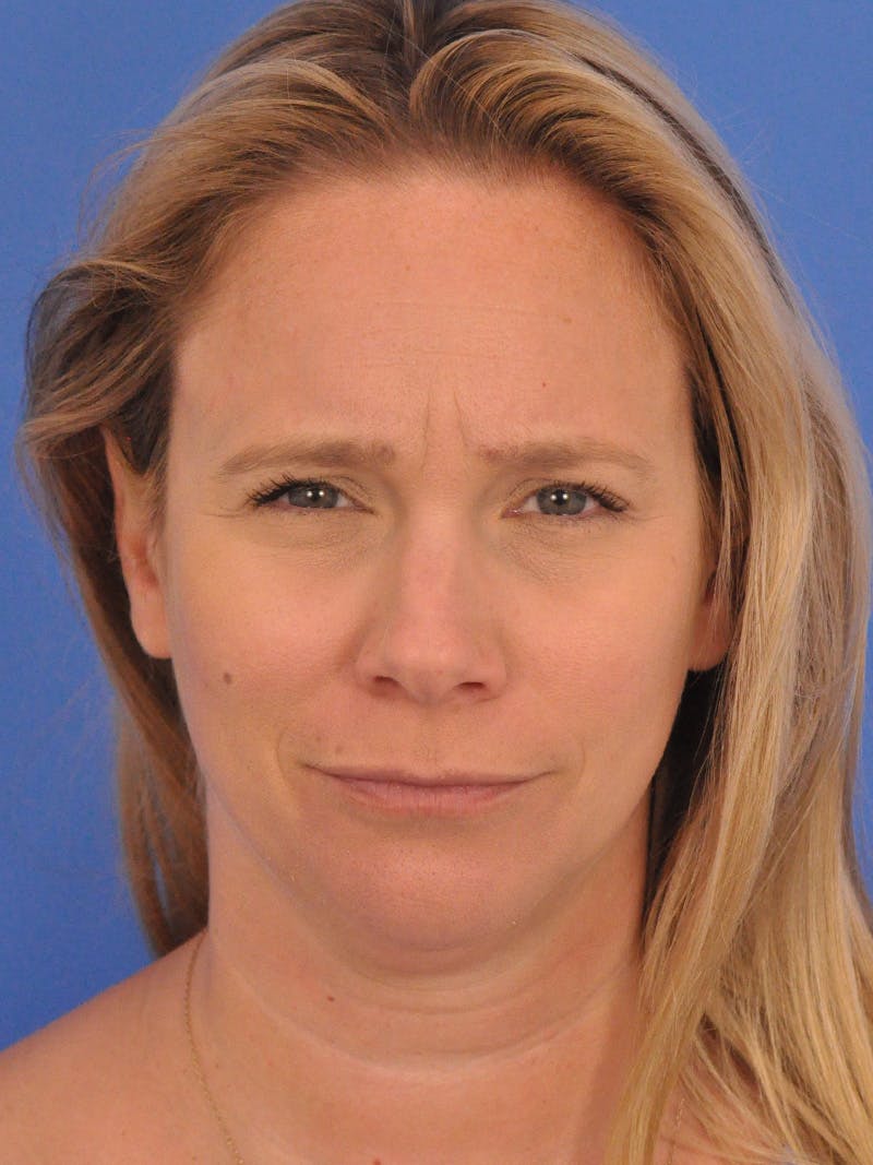 BOTOX Before & After Gallery - Patient 749775 - Image 1