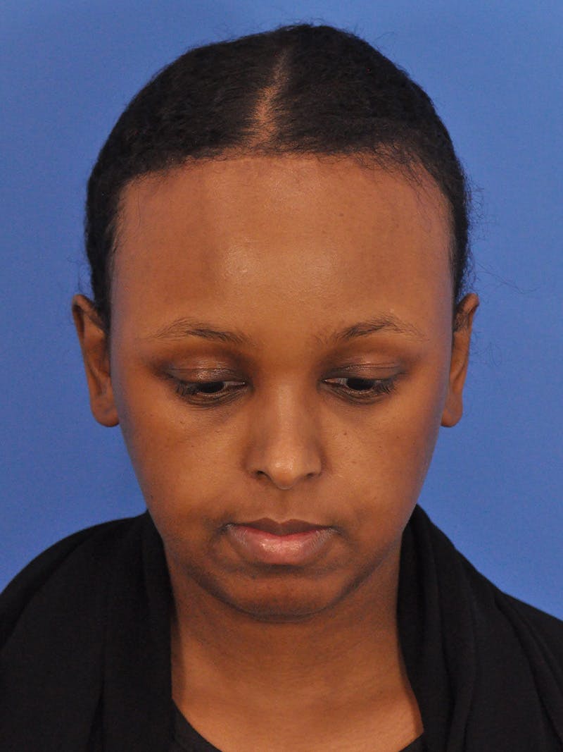 Forehead Reduction Before & After Gallery - Patient 196323 - Image 4