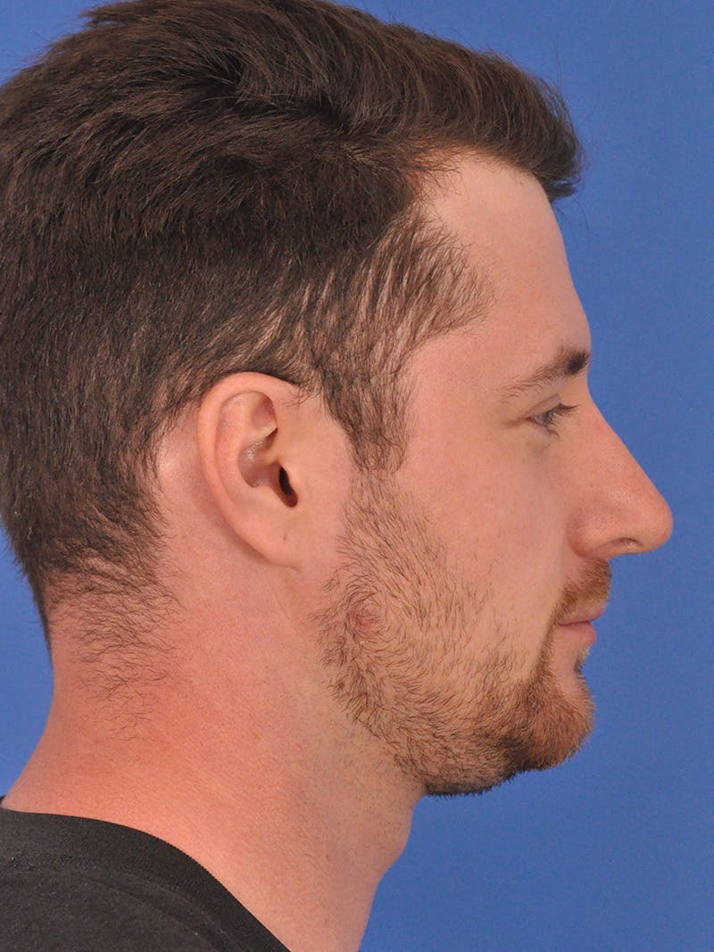 Chin Filler Before & After Gallery - Patient 228531 - Image 1