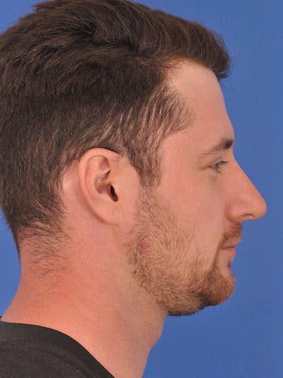 Chin Filler Before & After Gallery - Patient 228531 - Image 1