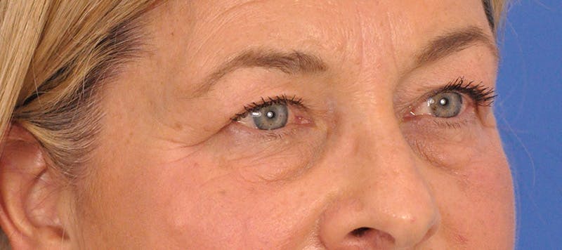 CO2RE Laser Before & After Gallery - Patient 140276 - Image 5