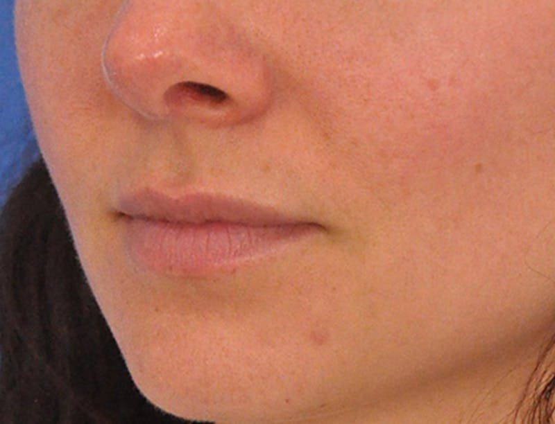 Lip Filler Before & After Gallery - Patient 829353 - Image 9