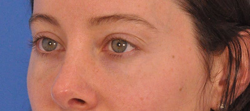 Tear Trough Filler Before & After Gallery - Patient 265185 - Image 9