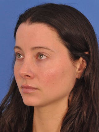 Cheek Filler Before & After Gallery - Patient 385411 - Image 10