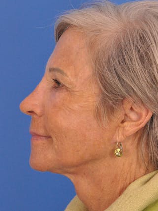 Blepharoplasty Before & After Gallery - Patient 341741 - Image 10