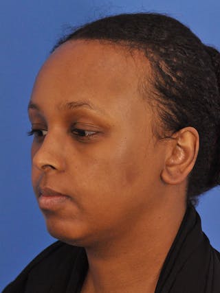 Forehead Reduction Before & After Gallery - Patient 196323 - Image 10