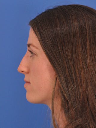 Liquid Rhinoplasty Before & After Gallery - Patient 395172 - Image 12