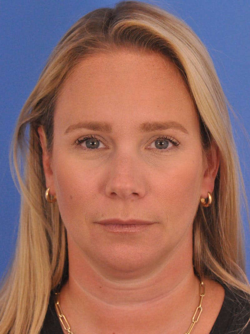 BOTOX Before & After Gallery - Patient 749775 - Image 5