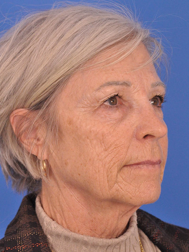 Neck Lift Before & After Gallery - Patient 181998 - Image 3