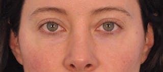 Tear Trough Filler Before & After Gallery - Patient 265185 - Image 4