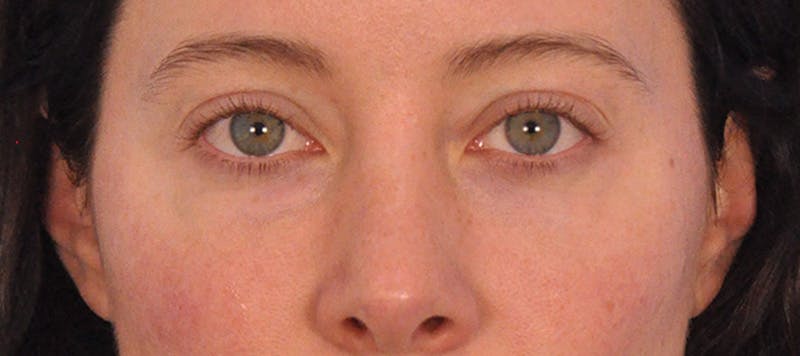 Tear Trough Filler Before & After Gallery - Patient 265185 - Image 4