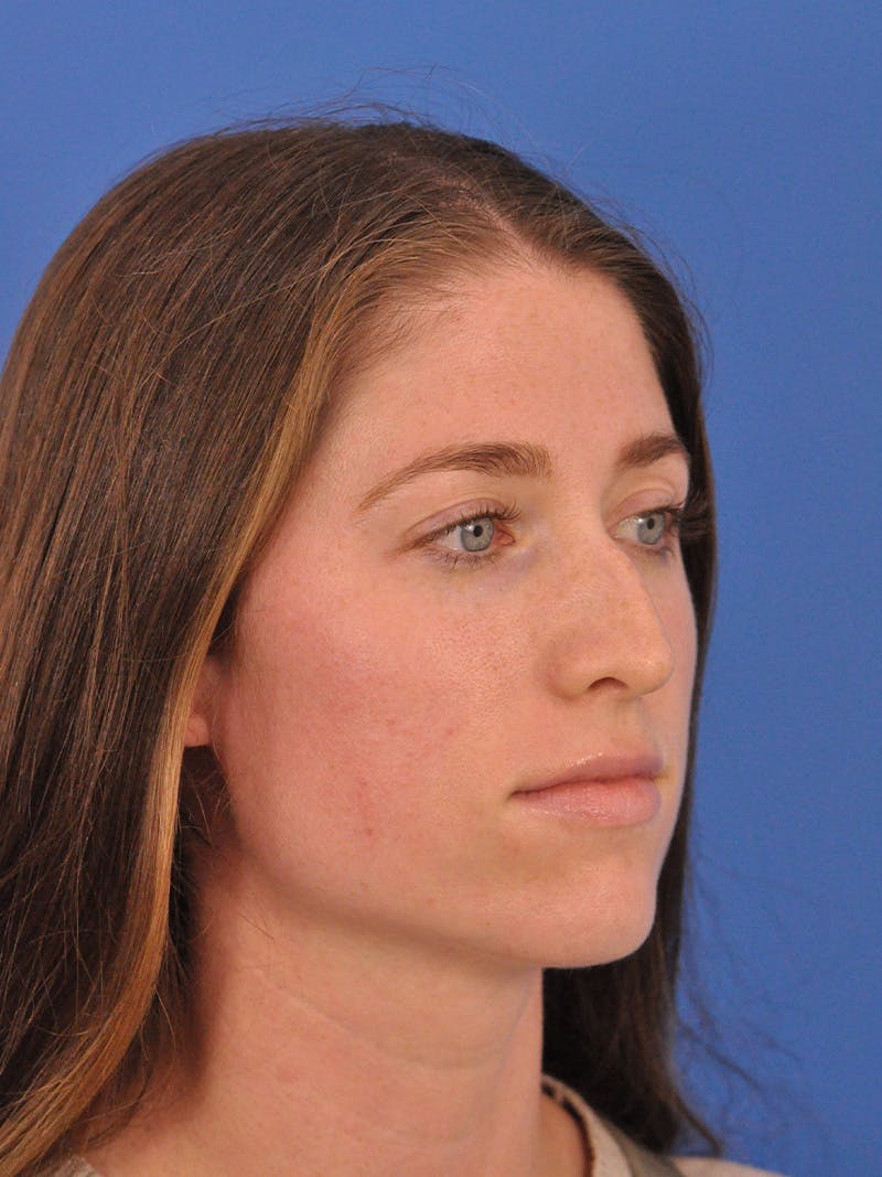 Liquid Rhinoplasty Before & After Gallery - Patient 395172 - Image 3
