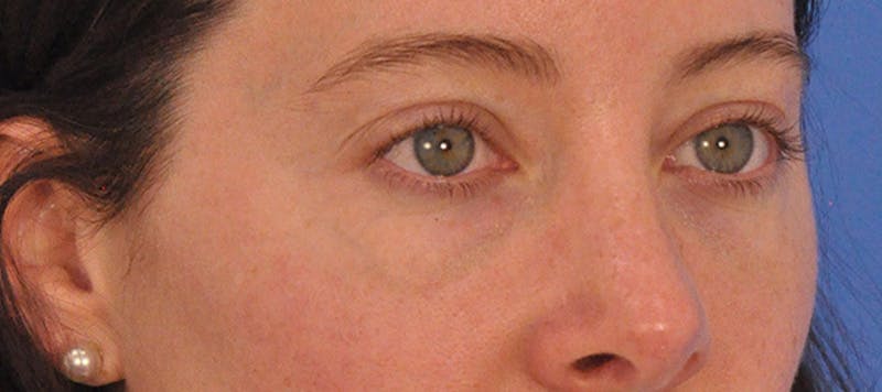 Tear Trough Filler Before & After Gallery - Patient 265185 - Image 5