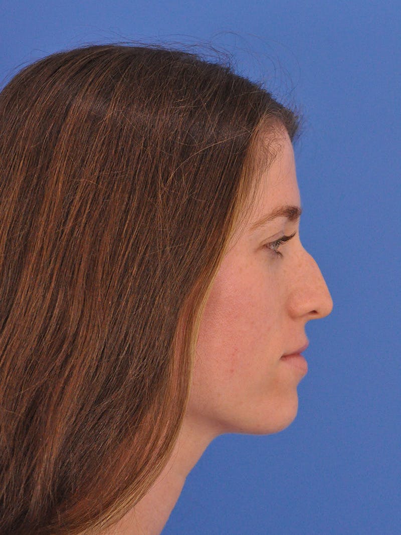 Liquid Rhinoplasty Before & After Gallery - Patient 395172 - Image 1