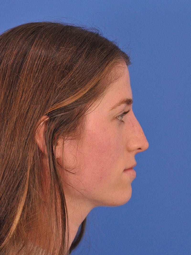 Liquid Rhinoplasty Before & After Gallery - Patient 395172 - Image 2