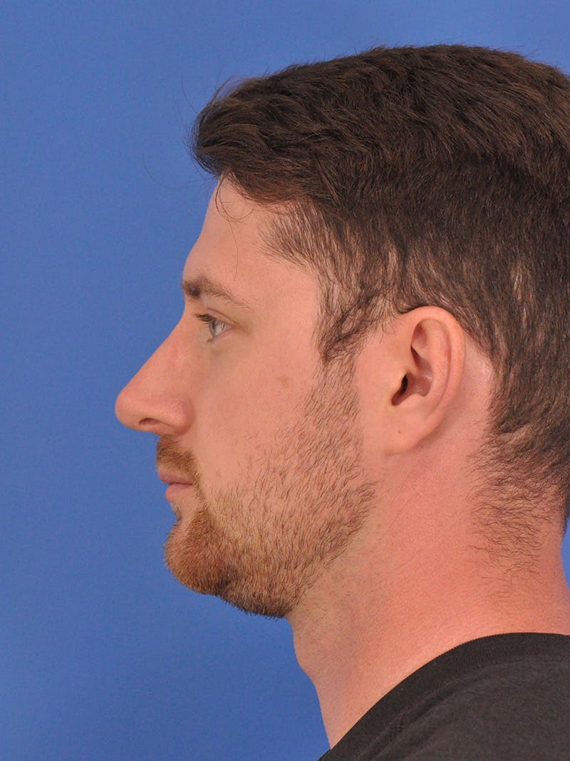 Chin Filler Before & After Gallery - Patient 228531 - Image 9