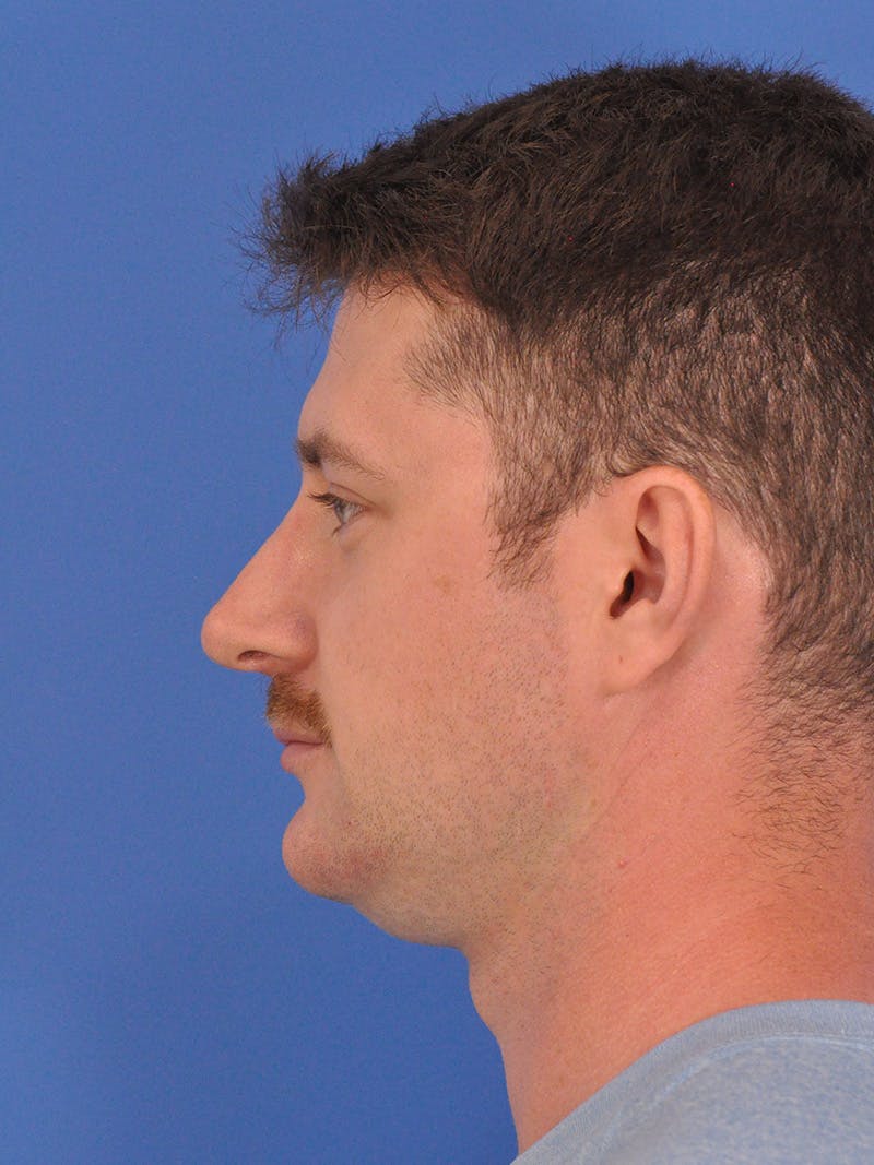 Chin Filler Before & After Gallery - Patient 228531 - Image 10