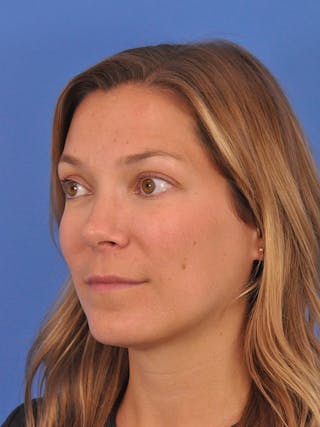 Cheek Filler Before & After Gallery - Patient 187973 - Image 12